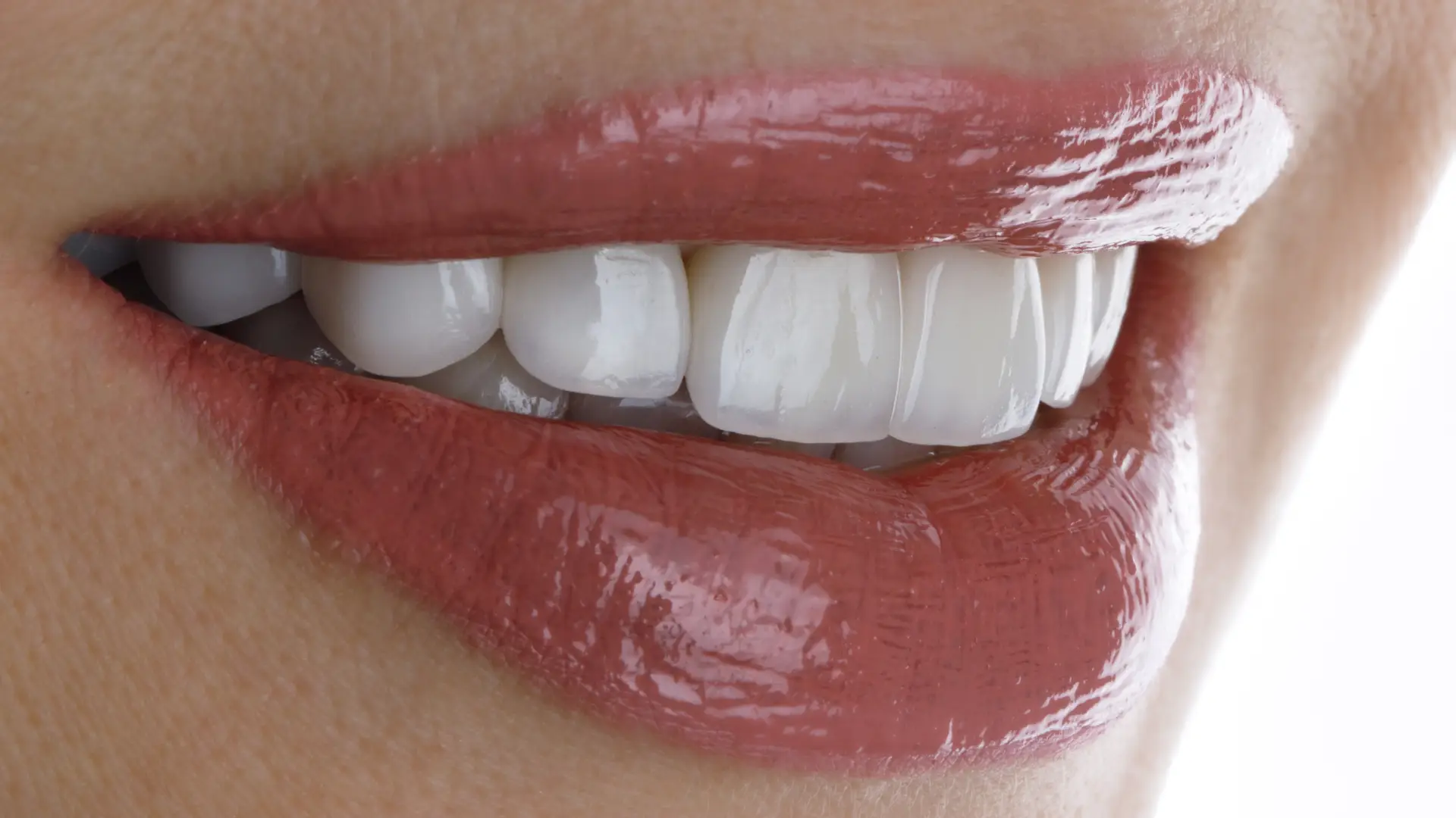 Smile Makeover | Dr. Enrico Cogo | Cometic Dentist in Dubai