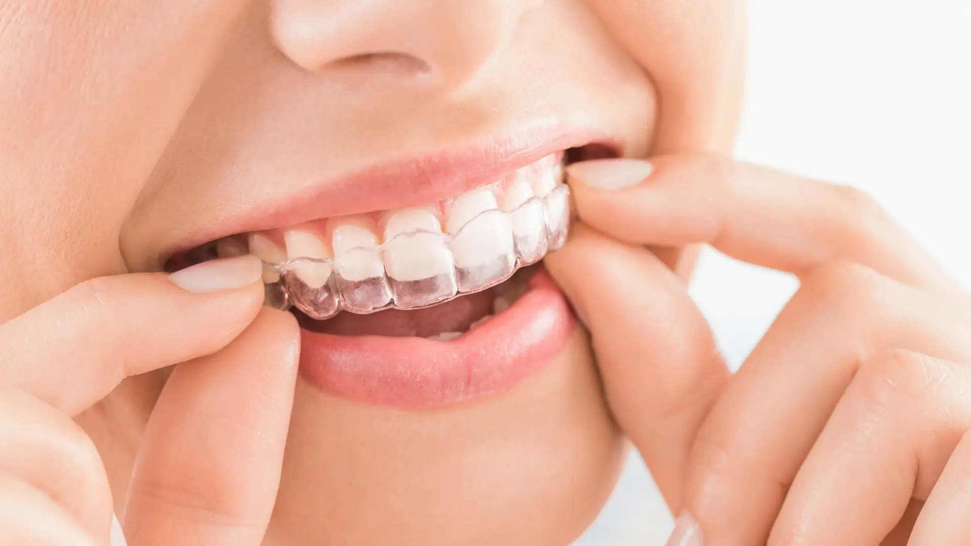 Invisalign | Dr. Enrico Cogo | Cometic Dentist in Dubai