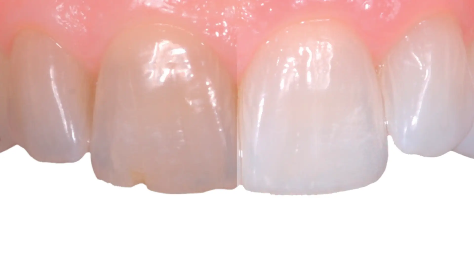 Teeth Whitening | Dr. Enrico Cogo | Cometic Dentist in Dubai