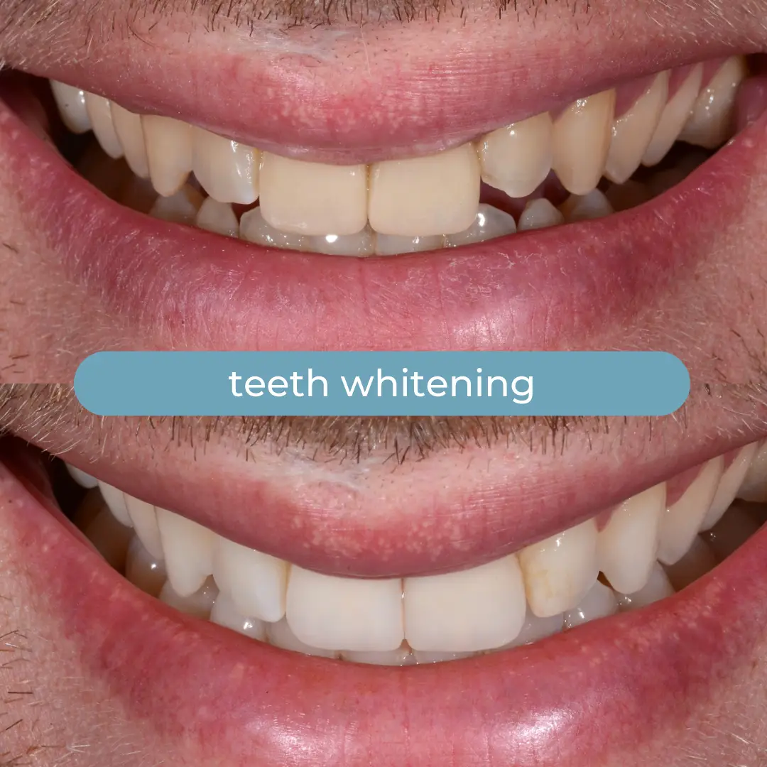 Sbiancamento Dentale | Dr. Enrico Cogo | Dentista Estetico Italiano a Dubai