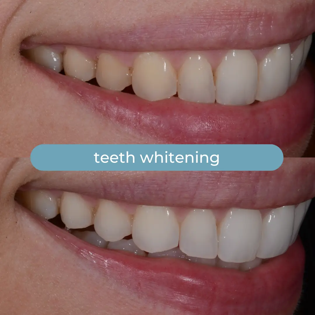 Sbiancamento Dentale | Dr. Enrico Cogo | Dentista Estetico Italiano a Dubai