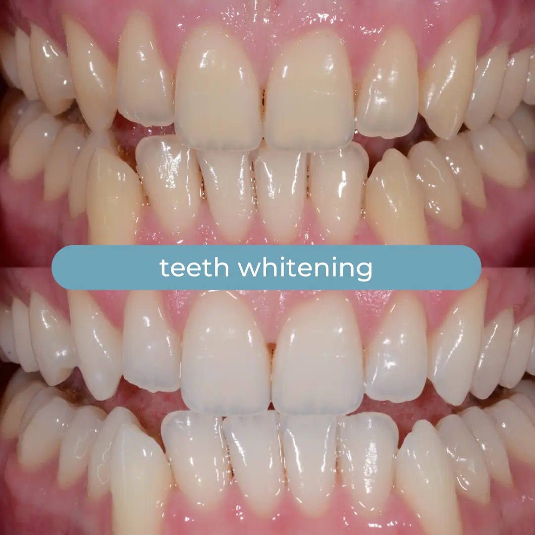 Sbiancamento Dentale | Dr. Enrico Cogo | Dentista Estetico Italiano a Dubai