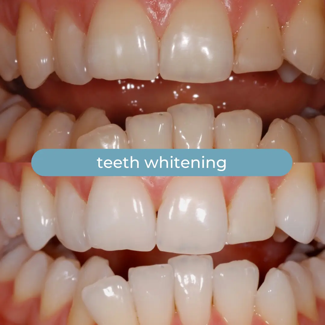Sbiancamento Dentale | Dr. Enrico Cogo | Dentista Estetico Italiano a Dubai