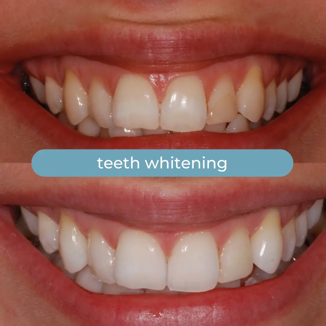 Sbiancamento Dentale | Dr. Enrico Cogo | Dentista Estetico Italiano a Dubai