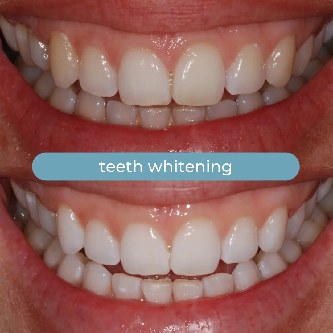 Sbiancamento Dentale | Dr. Enrico Cogo | Dentista Estetico Italiano a Dubai