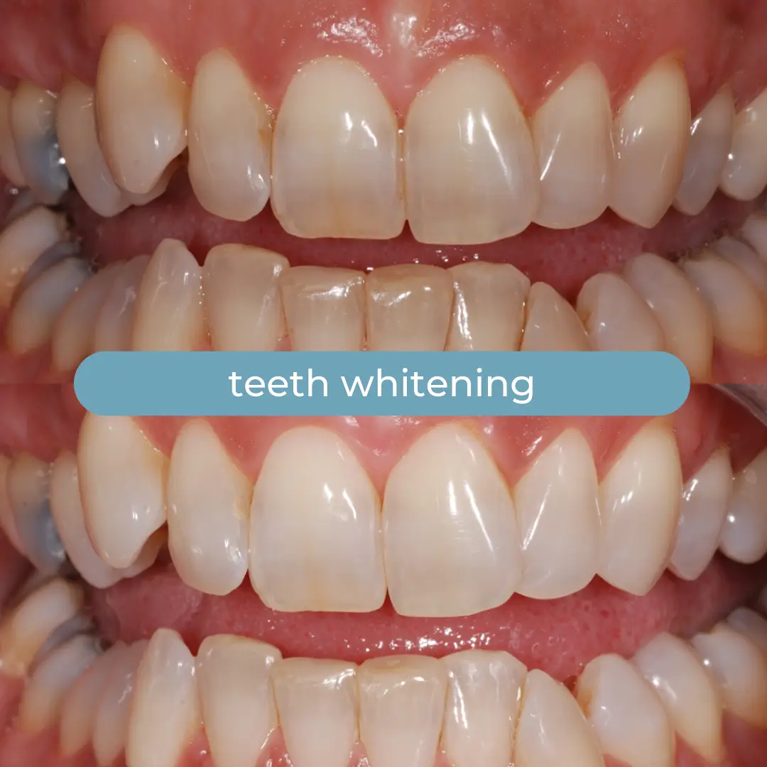 Sbiancamento Dentale | Dr. Enrico Cogo | Dentista Estetico Italiano a Dubai