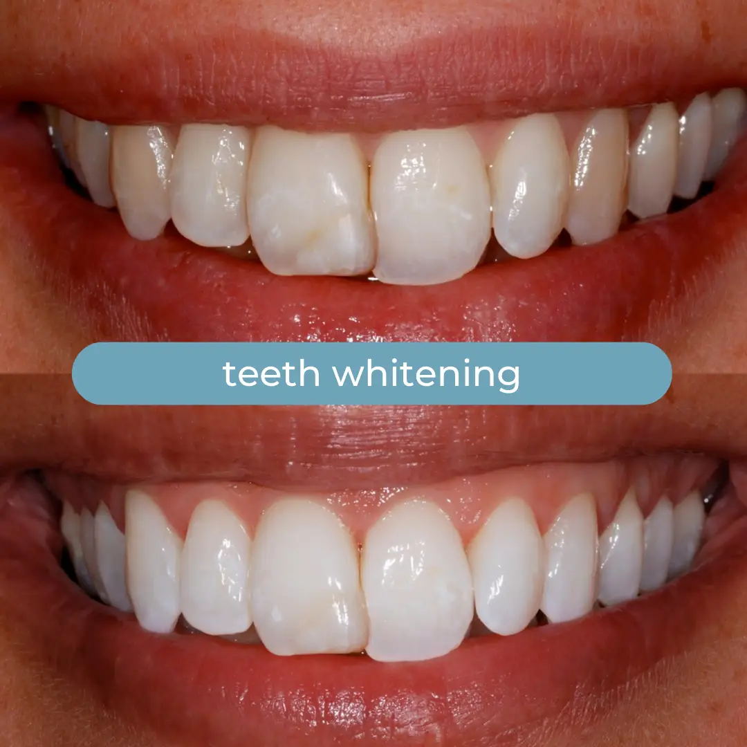 Sbiancamento Dentale | Dr. Enrico Cogo | Dentista Estetico Italiano a Dubai