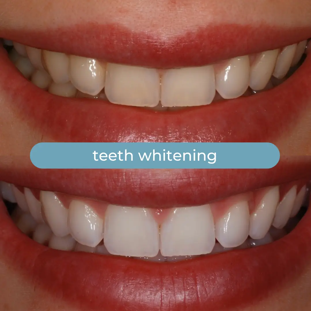 Sbiancamento Dentale | Dr. Enrico Cogo | Dentista Estetico Italiano a Dubai