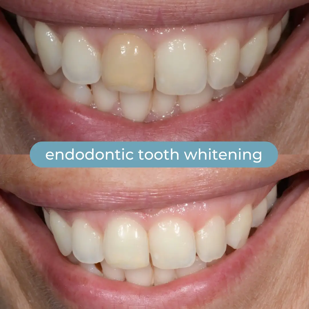 Teeth Whitening | Dr. Enrico Cogo | Cosmetic Dentist in Dubai