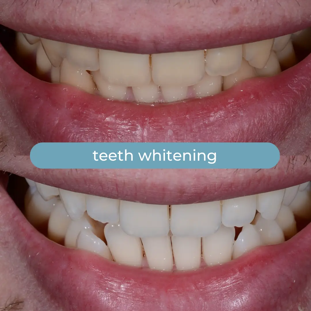 Sbiancamento Dentale | Dr. Enrico Cogo | Dentista Estetico Italiano a Dubai