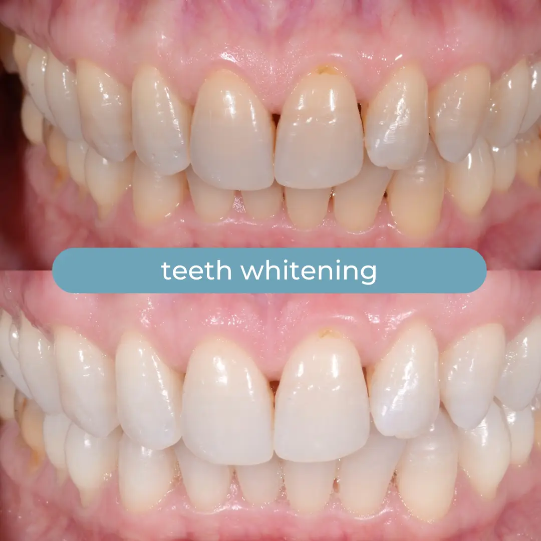 Teeth Whitening | Dr. Enrico Cogo | Cosmetic Dentist in Dubai
