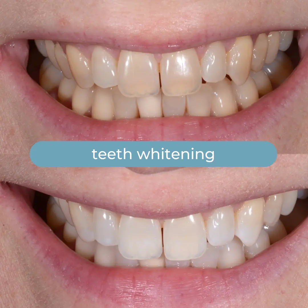 Teeth Whitening | Dr. Enrico Cogo | Cosmetic Dentist in Dubai