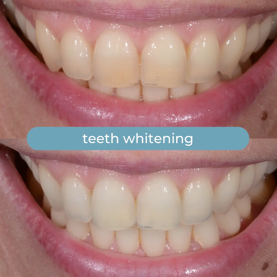 Teeth Whitening | Dr. Enrico Cogo | Cosmetic Dentist in Dubai