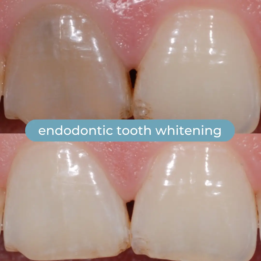 Sbiancamento Dentale | Dr. Enrico Cogo | Dentista Estetico Italiano a Dubai