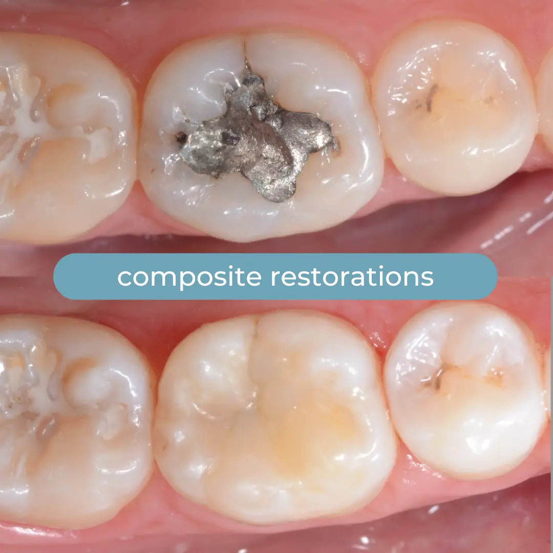 Composite Restorations | Dr. Enrico Cogo | Cosmetic Dentist in Dubai