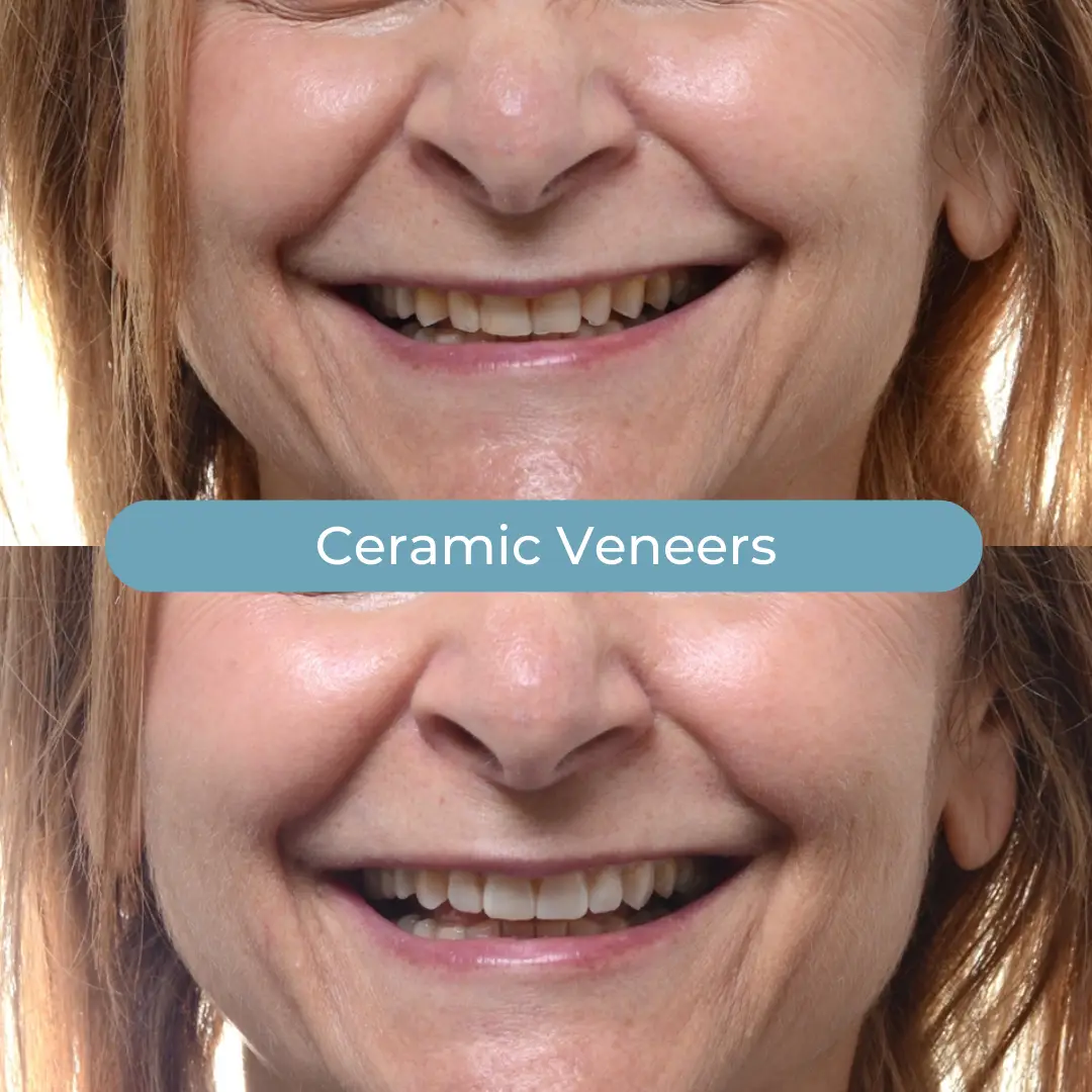 Veneers | Dr. Enrico Cogo | Cosmetic Dentist in Dubai