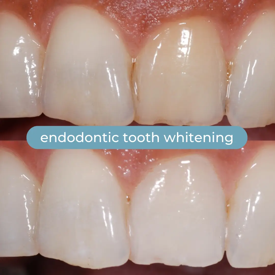 Sbiancamento Dentale | Dr. Enrico Cogo | Dentista Estetico Italiano a Dubai