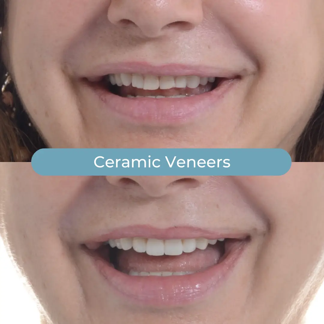 Veneers | Dr. Enrico Cogo | Cosmetic Dentist in Dubai