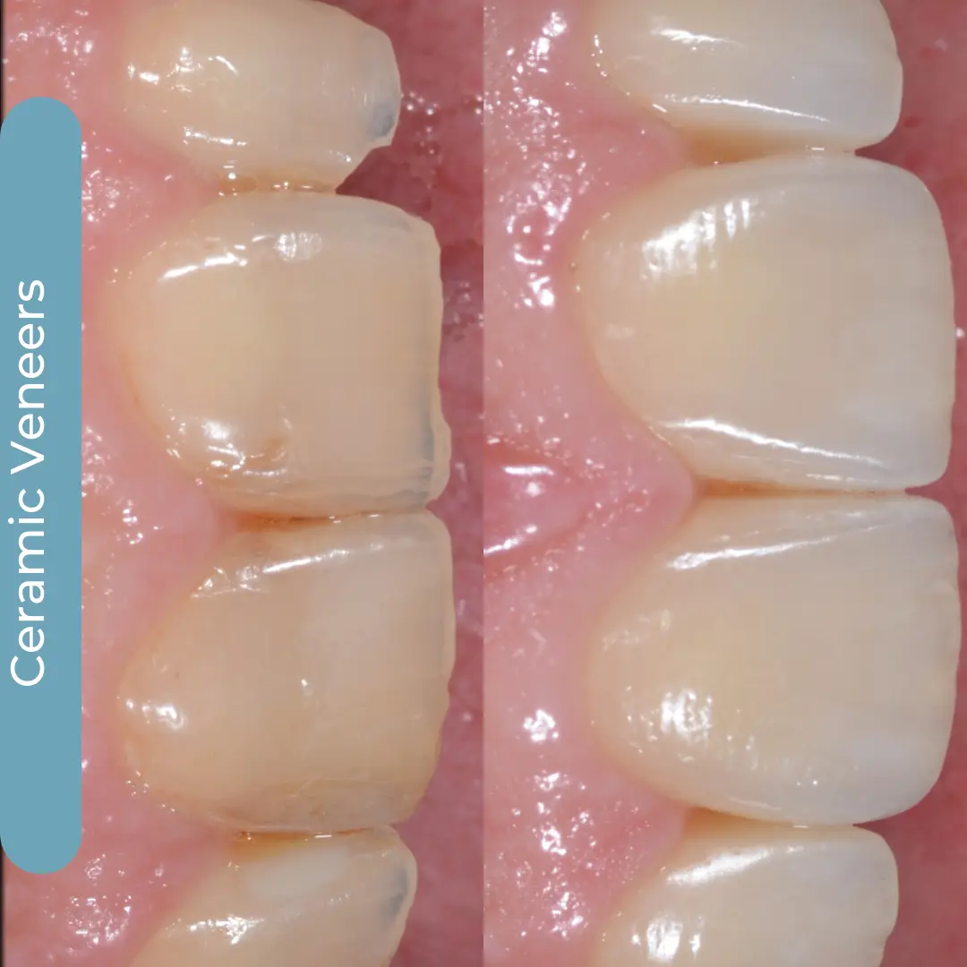Faccette Dentali | Dr. Enrico Cogo | Dentista Estetico Italiano a Dubai