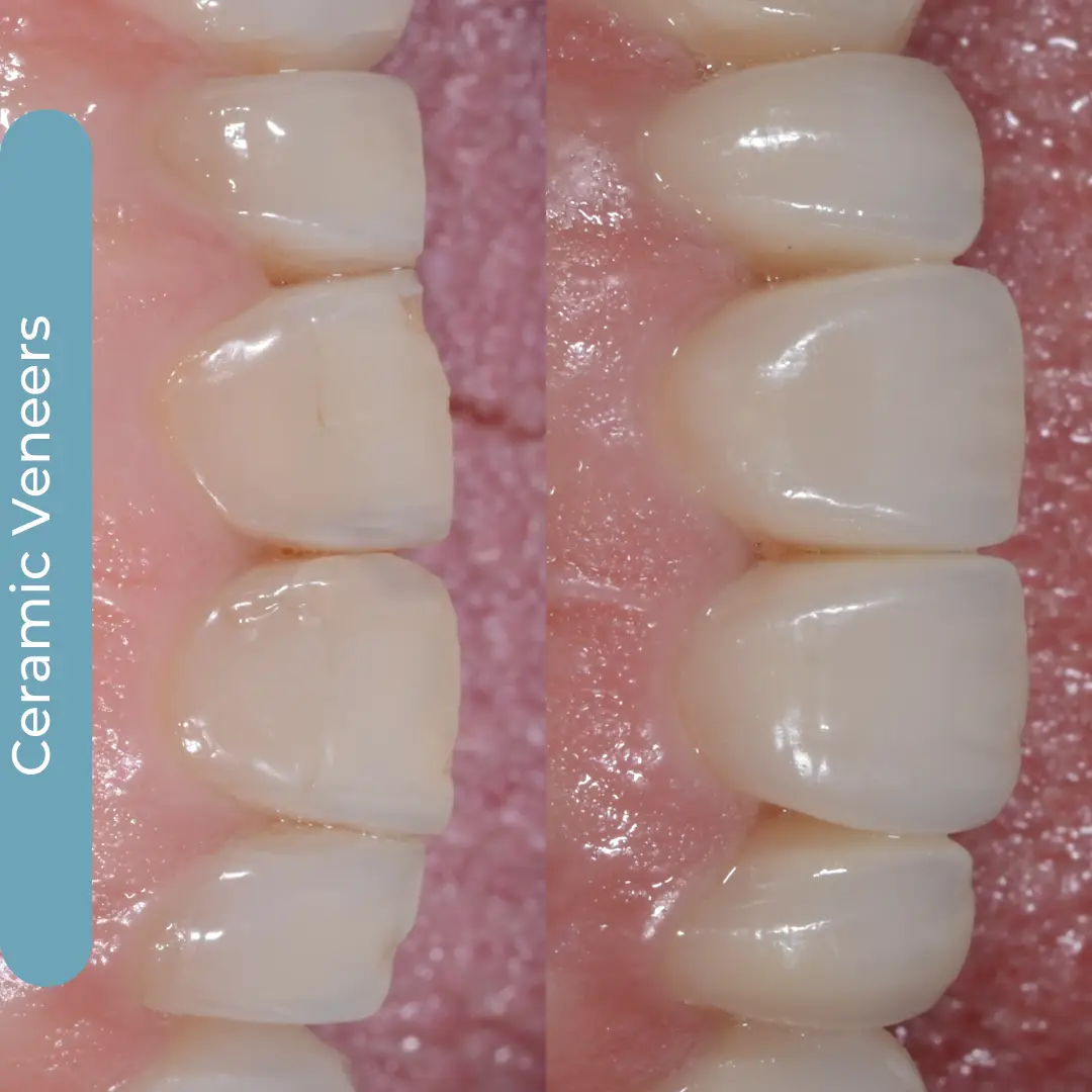Faccette Dentali | Dr. Enrico Cogo | Dentista Estetico Italiano a Dubai