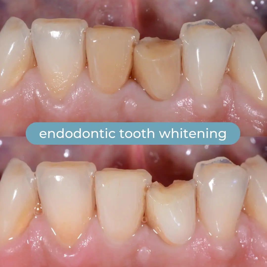 Sbiancamento Dentale | Dr. Enrico Cogo | Dentista Estetico Italiano a Dubai