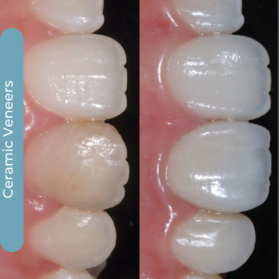 Faccette Dentali | Dr. Enrico Cogo | Dentista Estetico Italiano a Dubai