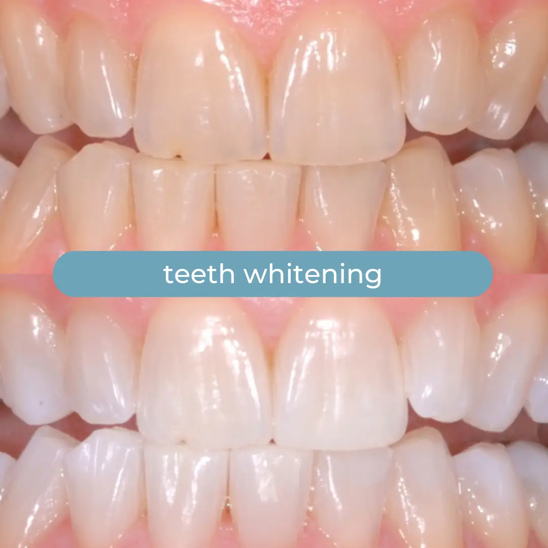 Teeth Whitening | Dr. Enrico Cogo | Cosmetic Dentist in Dubai