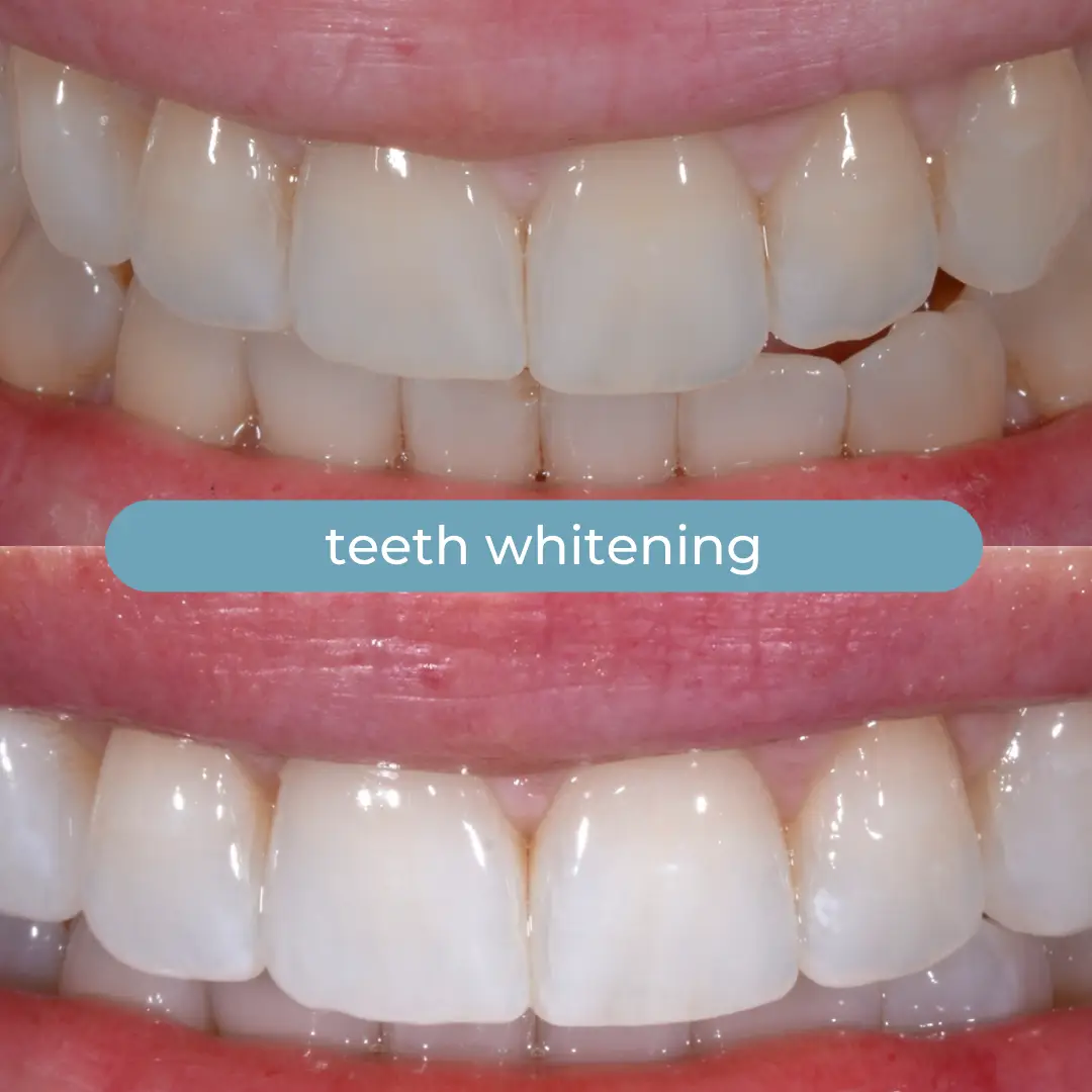 Sbiancamento Dentale | Dr. Enrico Cogo | Dentista Estetico Italiano a Dubai