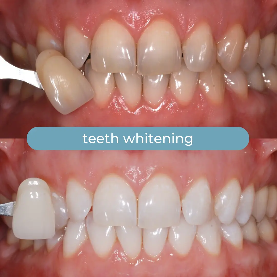 Sbiancamento Dentale | Dr. Enrico Cogo | Dentista Estetico Italiano a Dubai